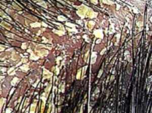 dermatite3