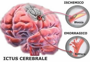 che cos'è un ictus e come riconoscerlo