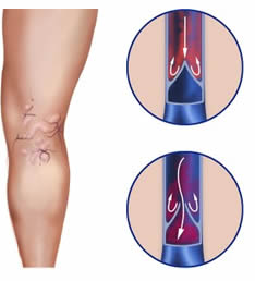 varicosis